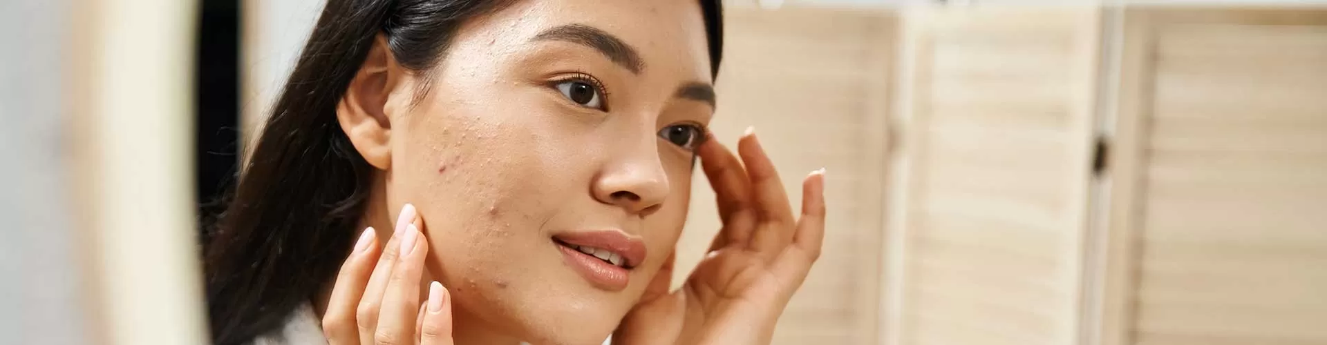 Acne Care