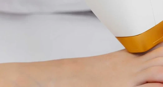 Laser Hair Removal on Foot (Female)