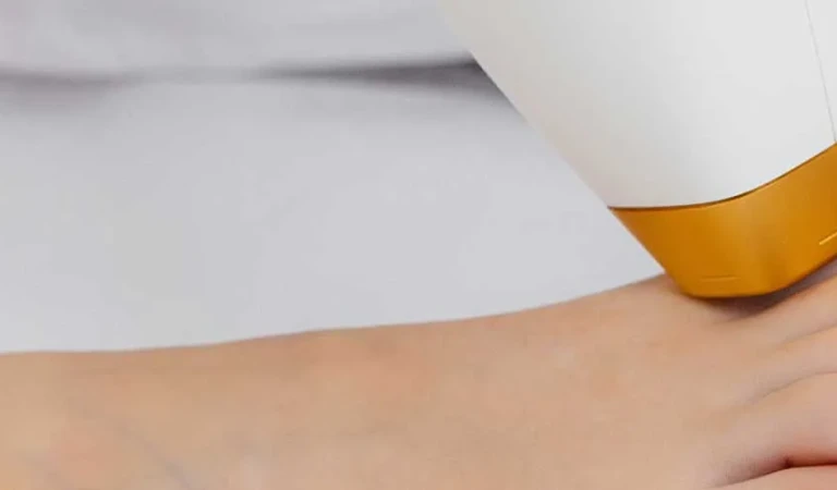 Laser Hair Removal on Foot (Female)