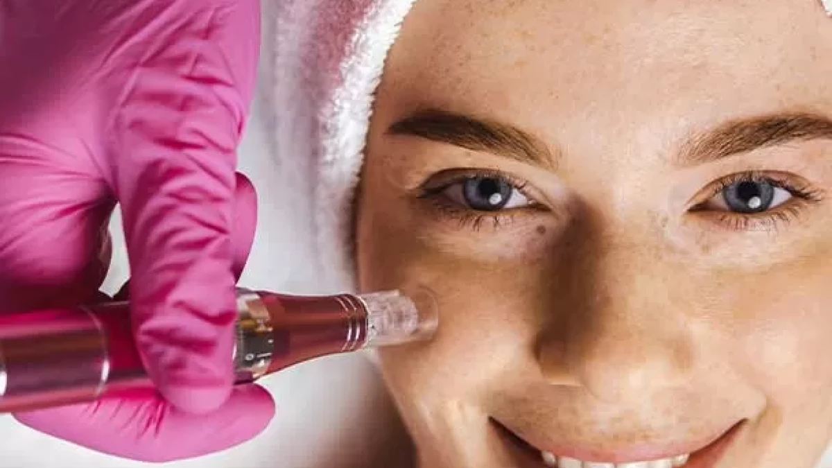 Dermapen For Skin Renewal