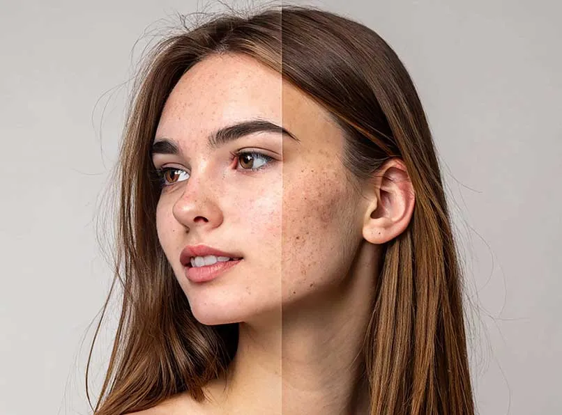 Leke Bakımı: SnowCell ile Cilt Tonu Eşitsizliklerine Çözüm