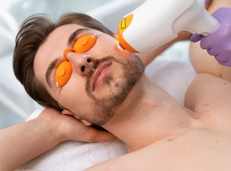Upper Beard Hair Removal: Lasting Solutions for Men