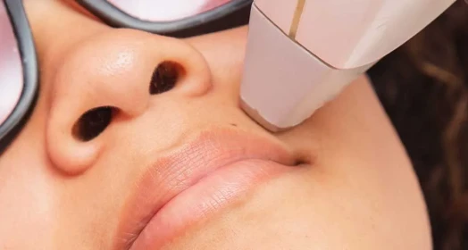 Upper Lip Laser Hair Removal (Female)