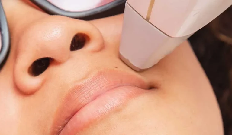 Upper Lip Laser Hair Removal (Female)