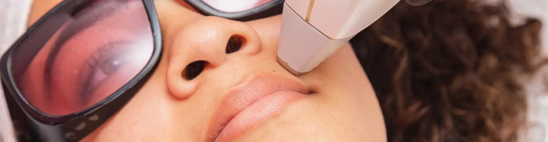 Upper Lip Laser Hair Removal (Female)