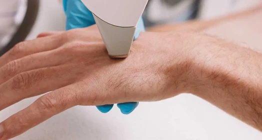 Handheld Laser Hair Removal (Male)