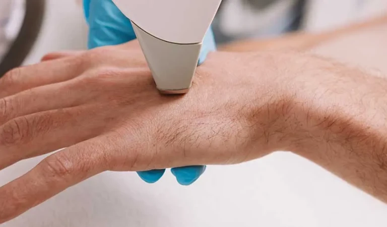 Handheld Laser Hair Removal (Male)