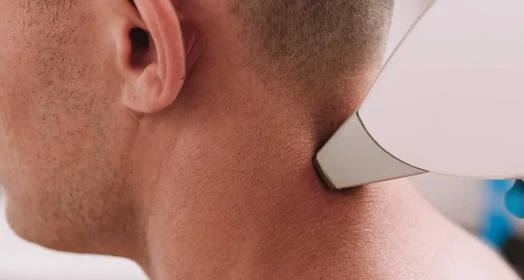 Nape Laser Hair Removal (Male)