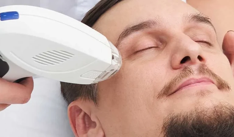 Whiskers Laser Hair Removal (Male)