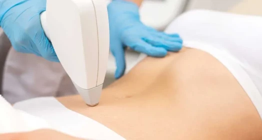 Navel Laser Hair Removal (Female)