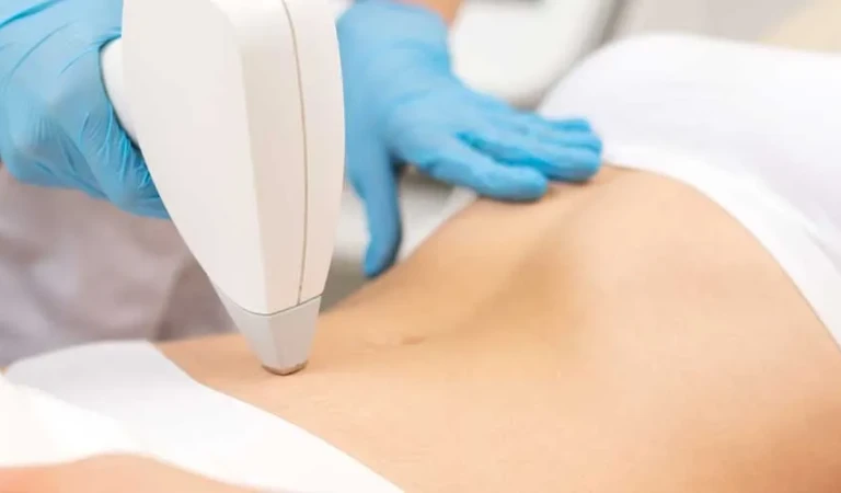 Navel Laser Hair Removal (Female)