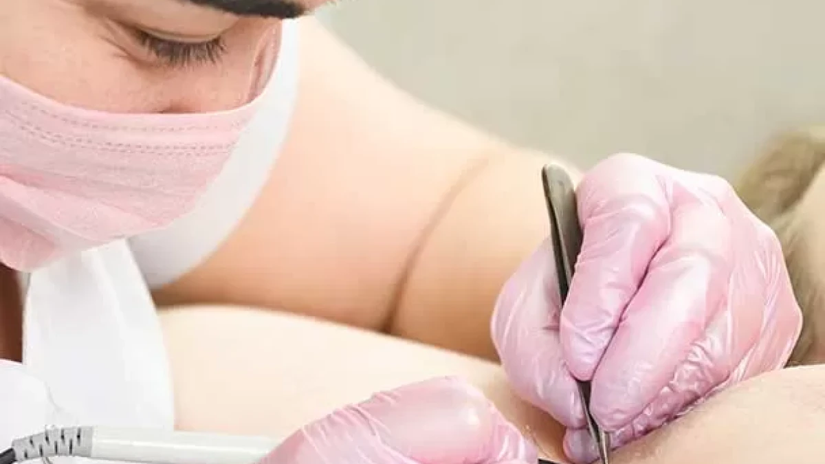 Needle Hair Removal