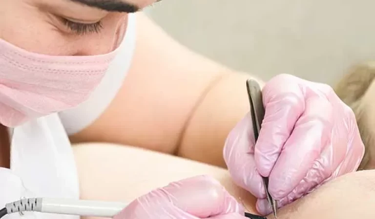 Needle Hair Removal