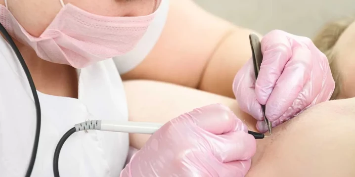 Needle Hair Removal