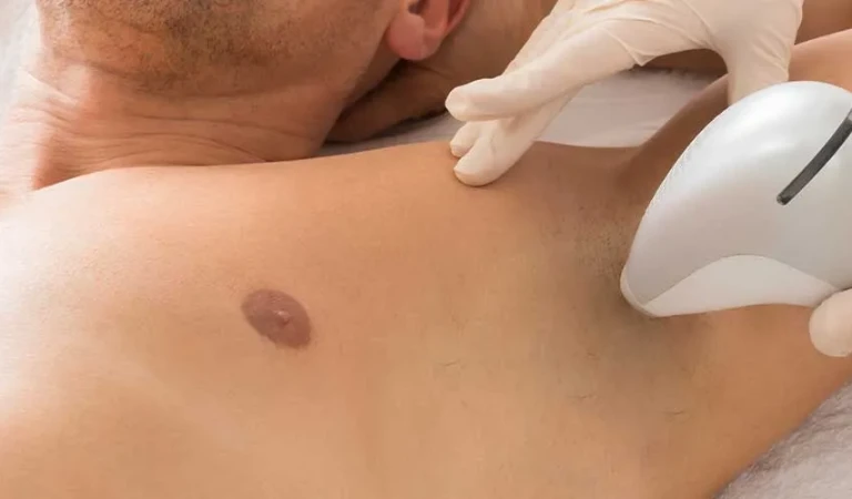 Armpit Laser Hair Removal (Male)