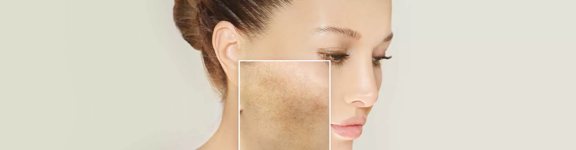 Leke Peeling