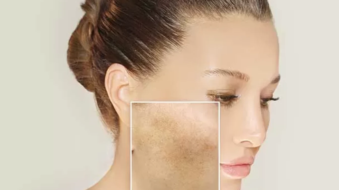 Blemish Removal