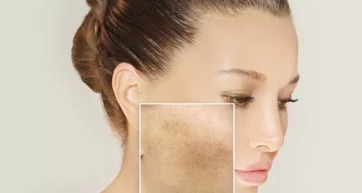 Blemish Removal