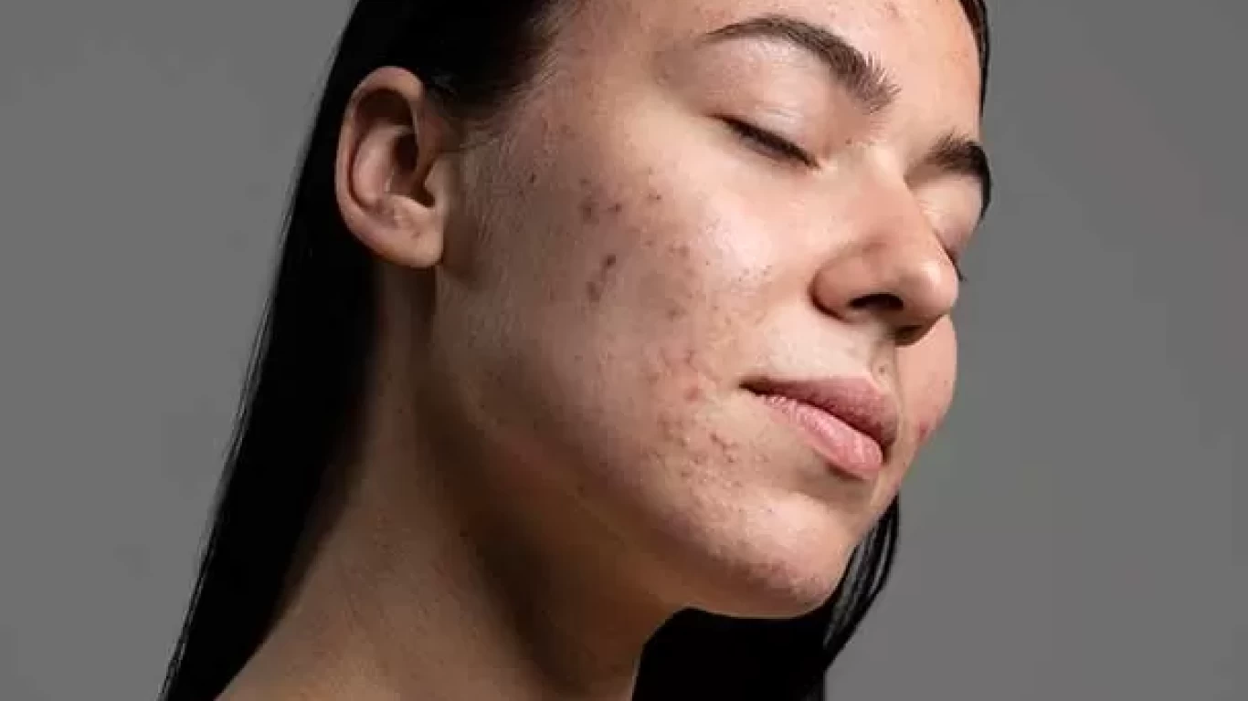 Innovations in Acne Care: What Are the Most Effective Solutions?