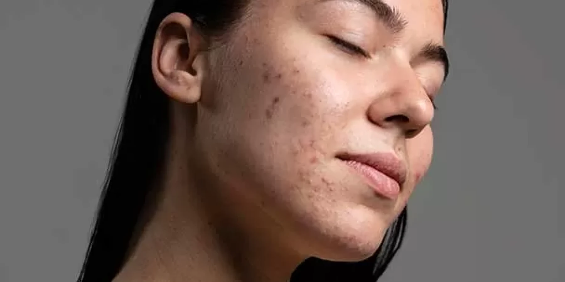 Akne Bakımında Yenilikler: Etkili Çözümler Nelerdir?