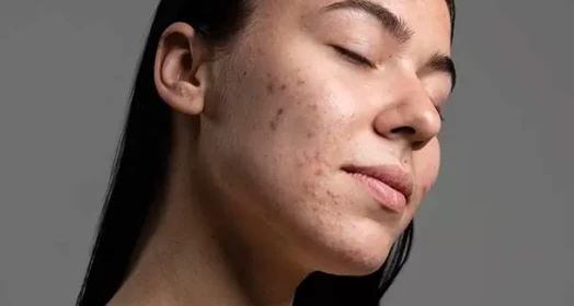Innovations in Acne Care: What Are the Most Effective Solutions?