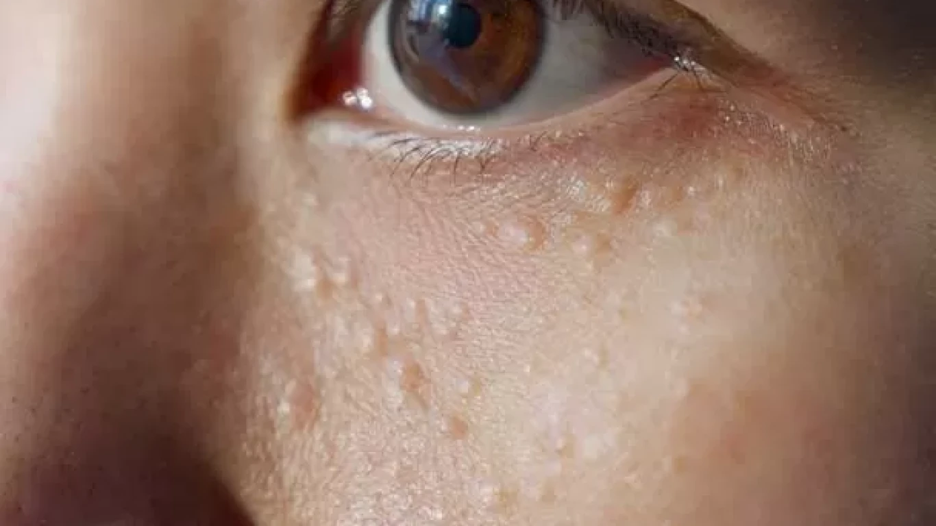 Milia Removal