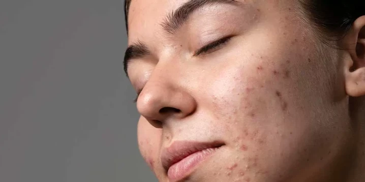 Akne Bakımında Yenilikler: Etkili Çözümler Nelerdir?