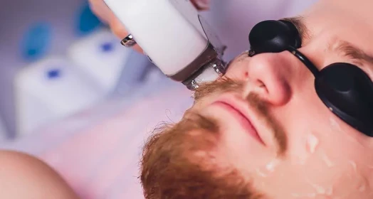 Sakal Üstü Epilasyon (Erkek)