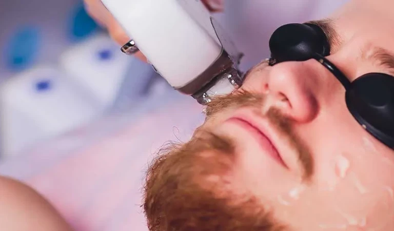 Laser Hair Removal on Beard (Male)