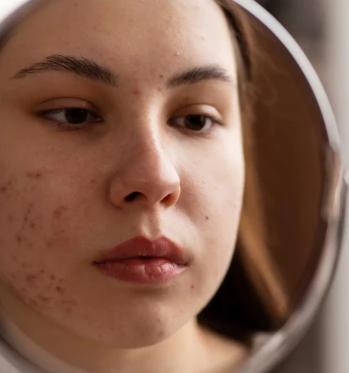 Akne Bakımı: Neden Profesyonel Yardım Almalısınız?