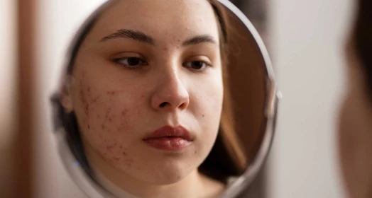 Akne Bakımı: Neden Profesyonel Yardım Almalısınız?