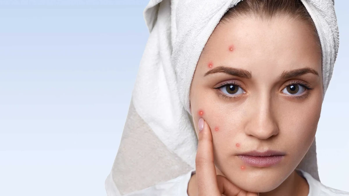 Effective and Lasting Solutions for Post-Acne Scars