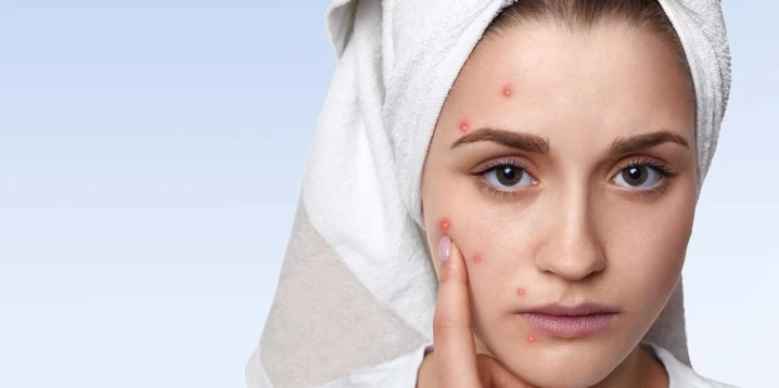 Effective and Lasting Solutions for Post-Acne Scars