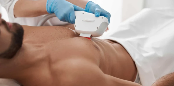 Men’s Laser Hair Removal Areas: Detailed Guide and Map