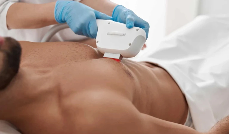 Men’s Laser Hair Removal Areas: Detailed Guide and Map