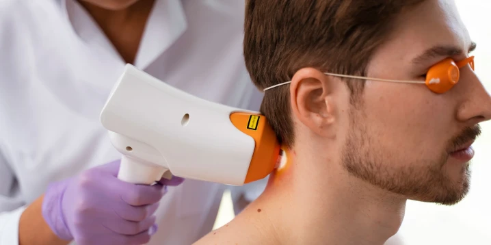 Men’s Laser Hair Removal: Back, Nape, and Beard Guide