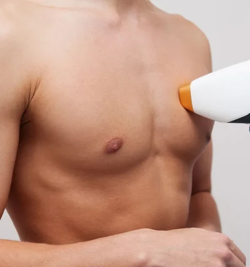 Erkek Lazer Epilasyon: Kalıcı Çözümler ve Güvenli Uygulamalar