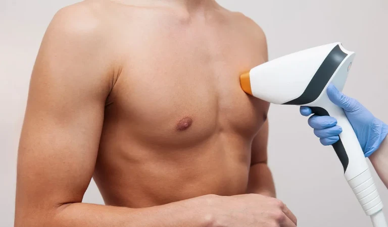 Men’s Laser Hair Removal: Effective and Safe Treatments