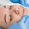 Spot and Acne Care: Personalized Solutions for Skin Blemishes