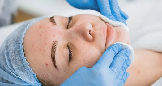 Spot and Acne Care: Personalized Solutions for Skin Blemishes