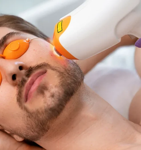 Sakal Üstü Epilasyon: Erkekler İçin Kalıcı ve Net Çözümler